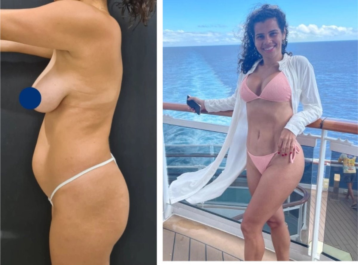 Avant et après augmentation mammaire chez Plastic Rio, forme et contour améliorés