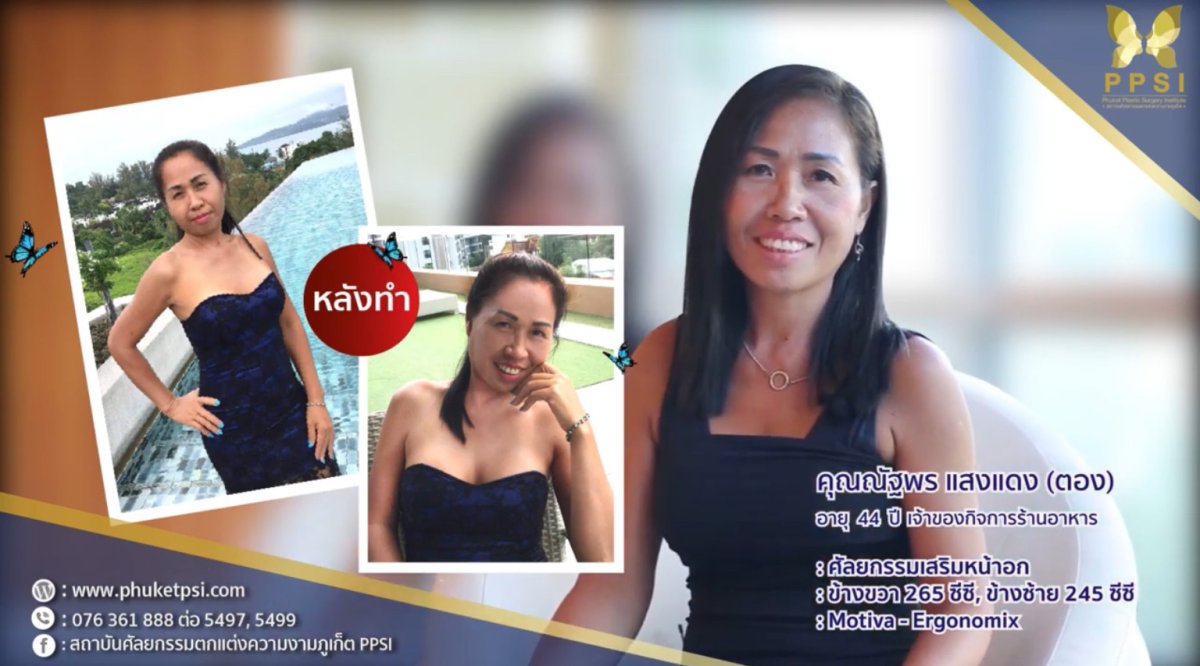 Результати збільшення грудей у Phuket Plastic Surgery Institute, природний вигляд бюсту