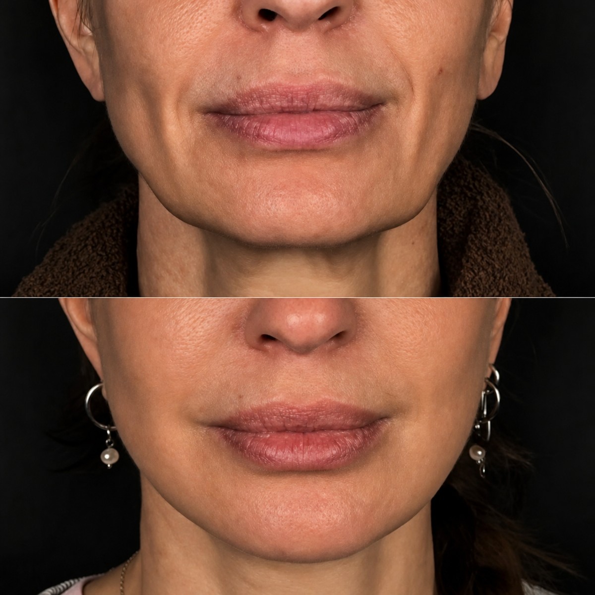 Facelift before and after results at Dmytrii Homola Clinic – smoother, youthful lower face