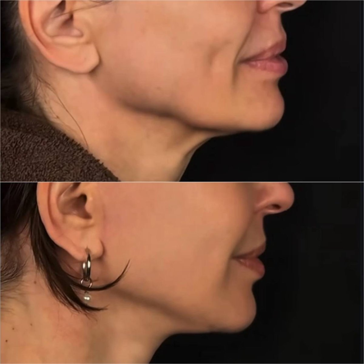 Resultados de lifting facial antes y después en Dmytrii Homola Clinic – mandíbula definida