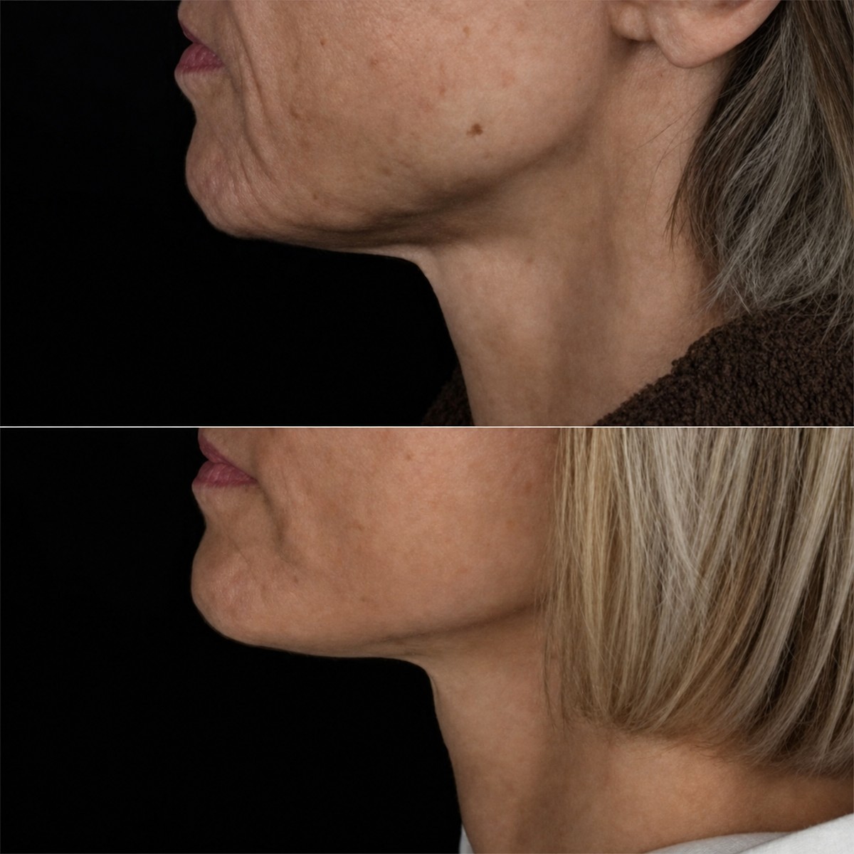Before and after facelift results at Dmytrii Homola Clinic – improved jawline and neck contour