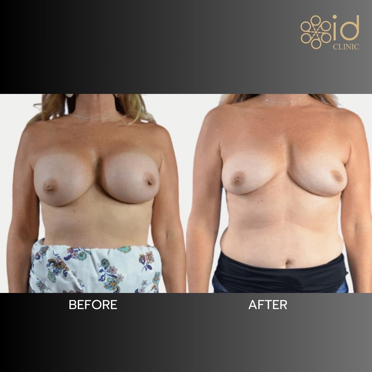 Before and after breast lift results at ID Clinic Bangkok, improved breast shape and contour