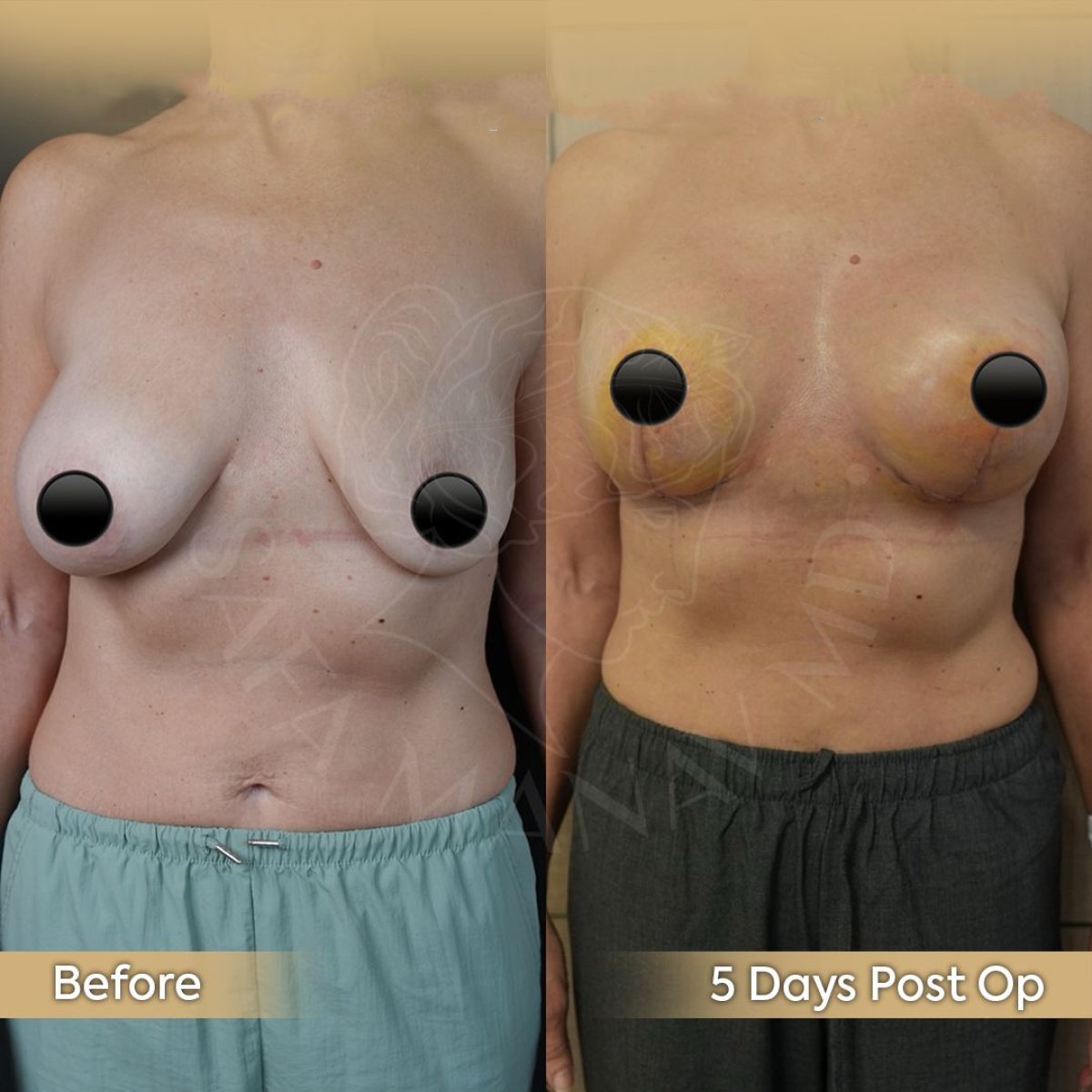 Resultados antes y después de revisión de implantes mamarios en Dr. Safa Manav Clinic, 5 días