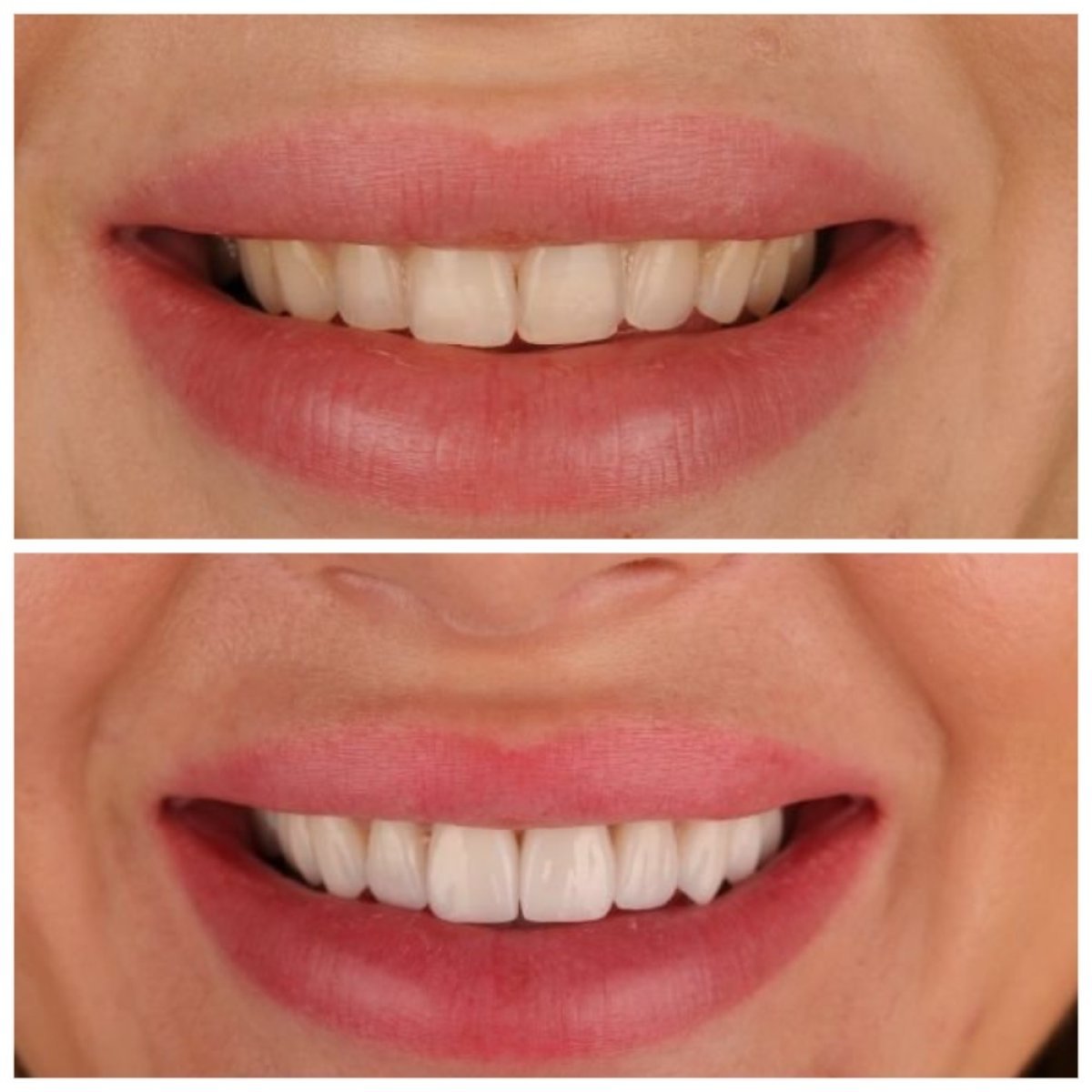 Avant et après facettes dentaires à RIKOTA Dental Clinic – transformation naturelle du sourire