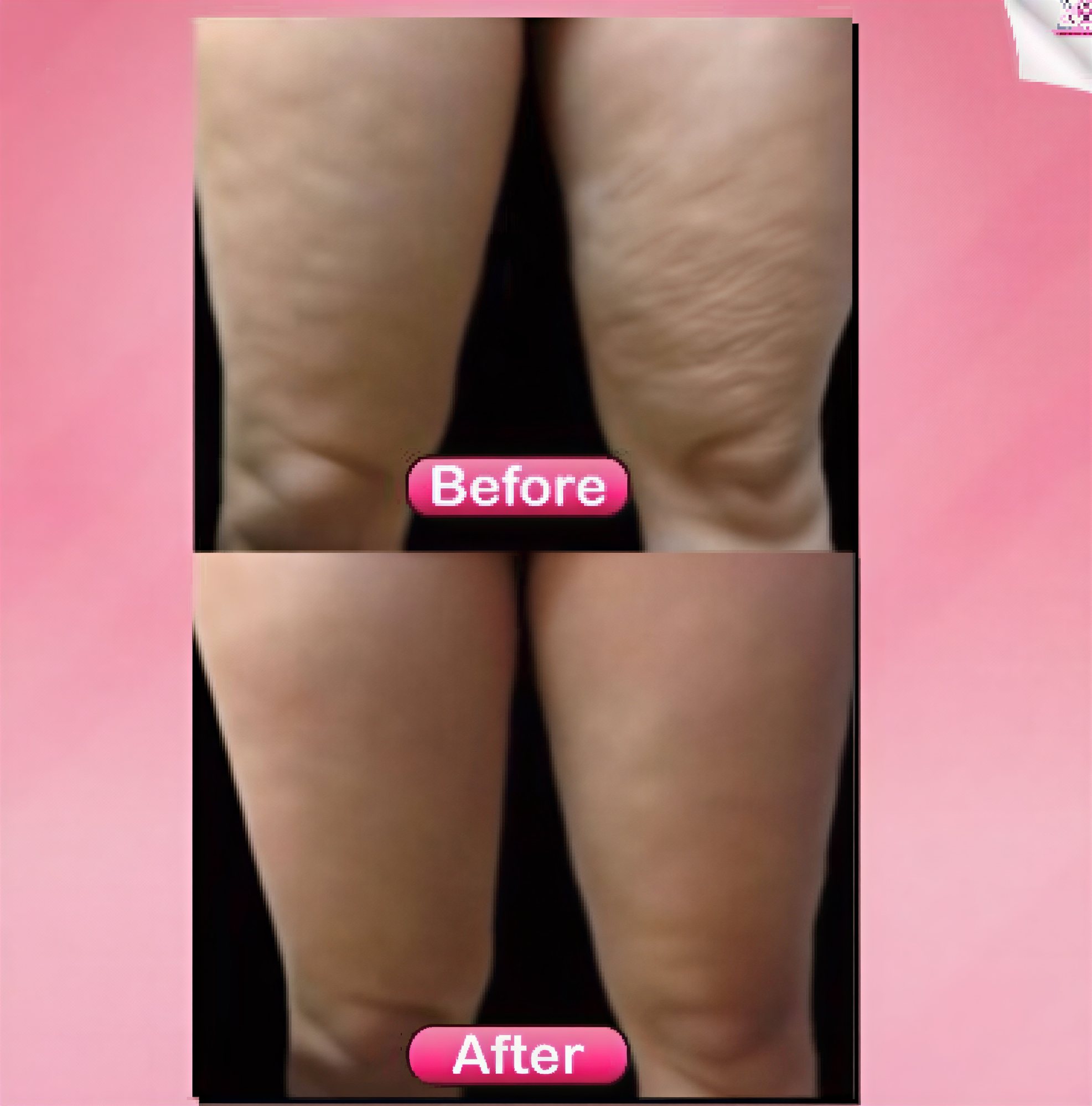 Before and after thigh lift results at Somchai Clinic – smoother, firmer thigh appearance