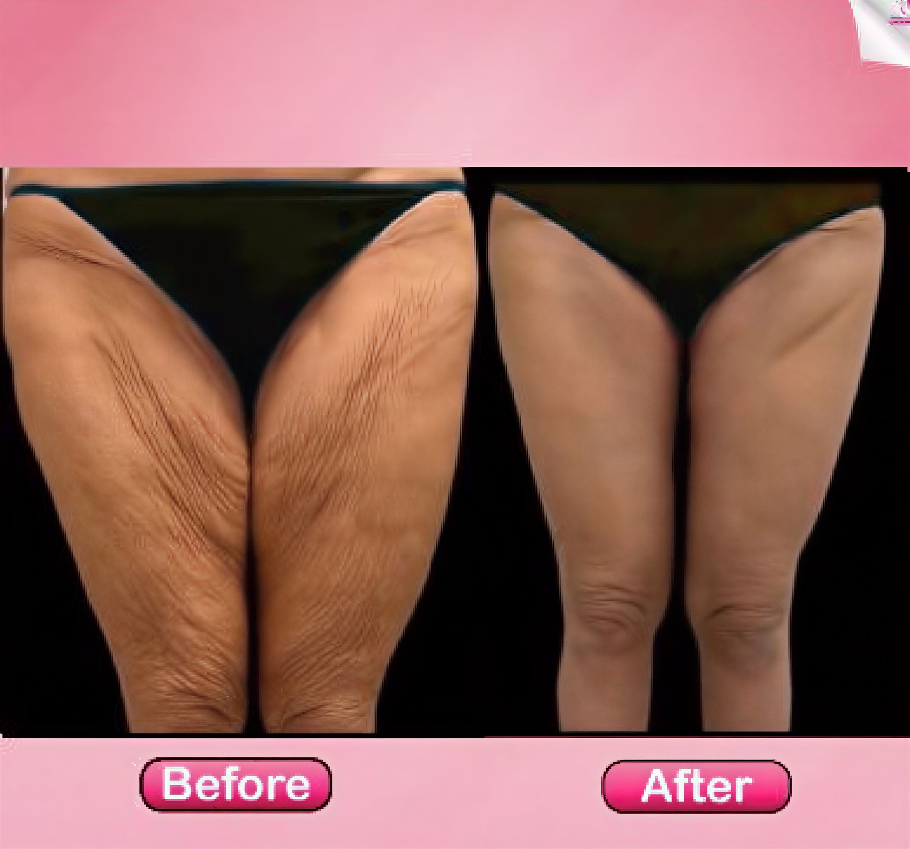 Before and after thigh lift results at Somchai Clinic – smoother, firmer thigh contour