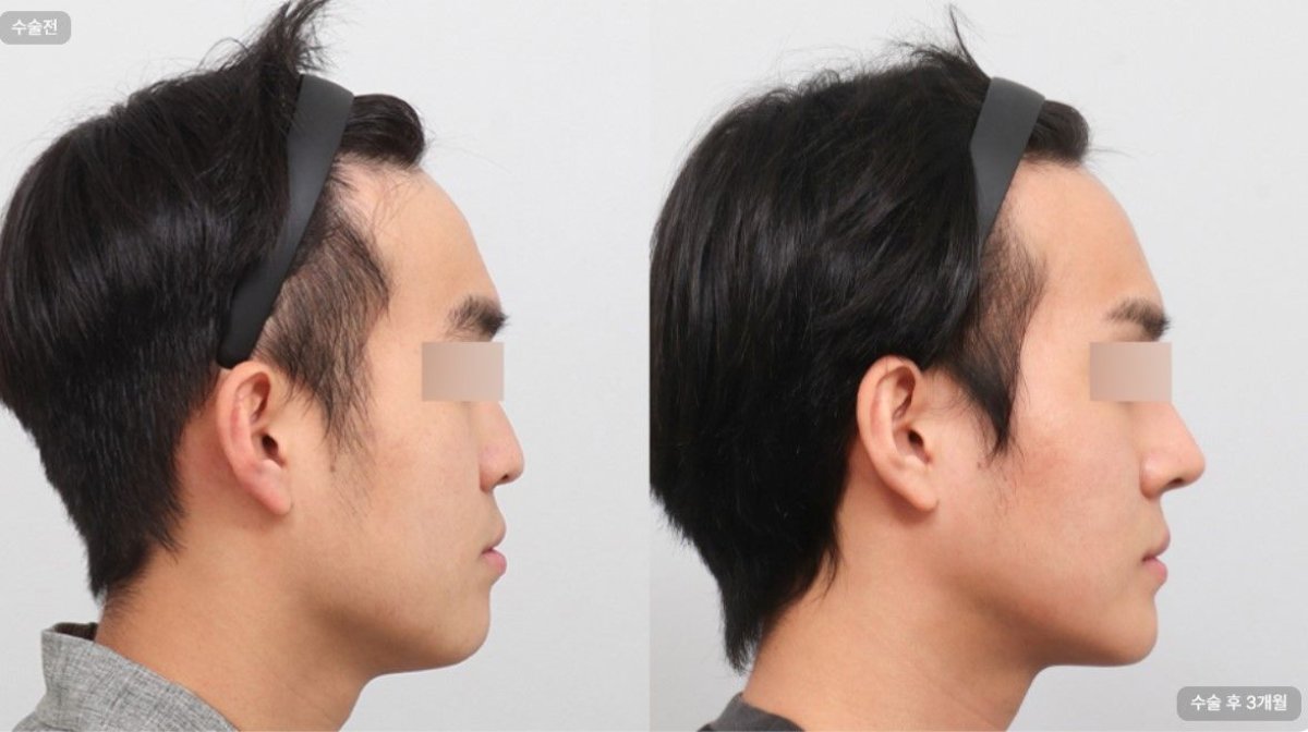 Resultados de rinoplastia antes y después en AB Plastic Surgery Clinic, perfil nasal mejorado