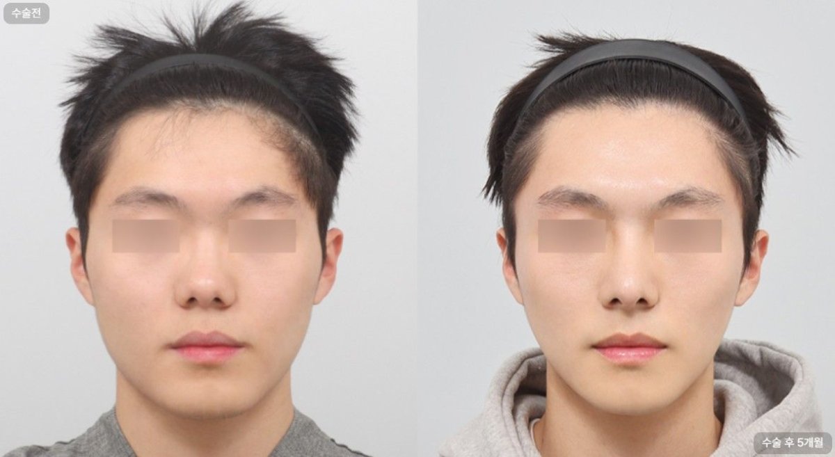 Результаты ринопластики до и после в AB Plastic Surgery Clinic, улучшена форма носа