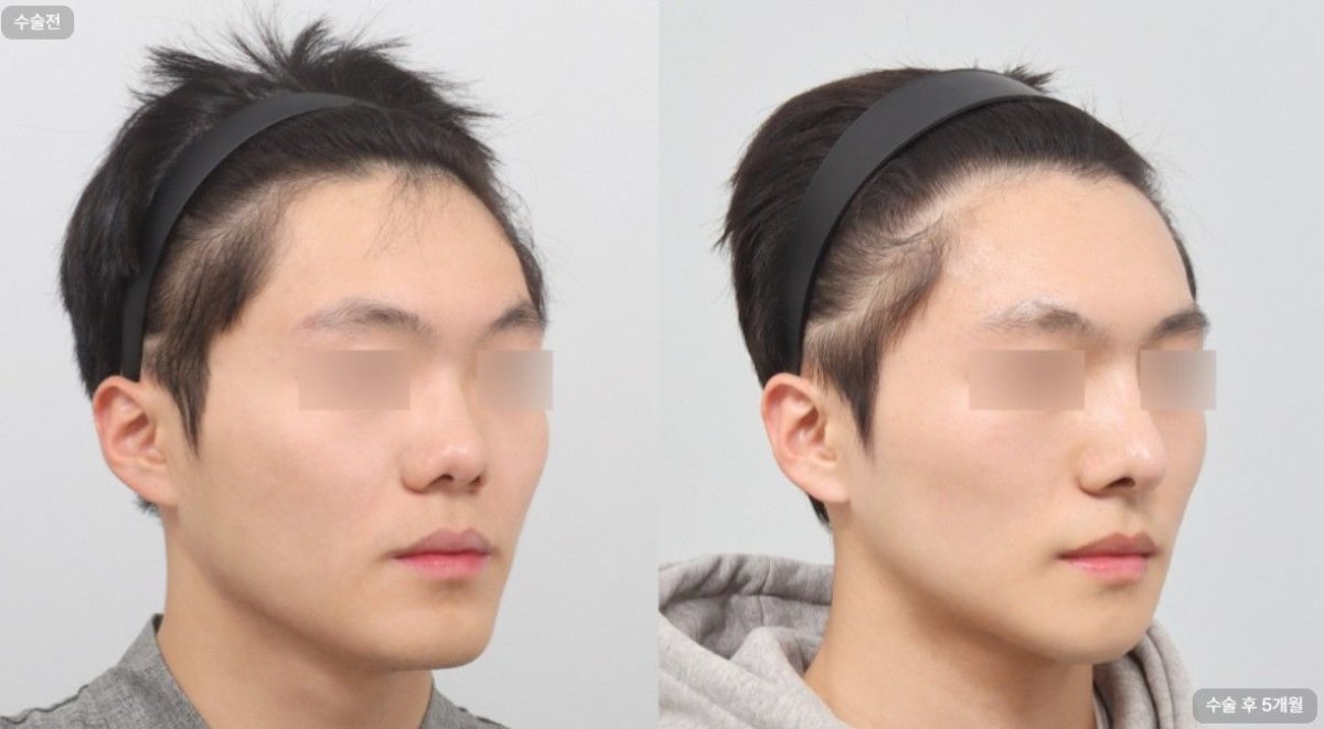 Before and after hair transplant results at AB Plastic Surgery Clinic, improved hairline density