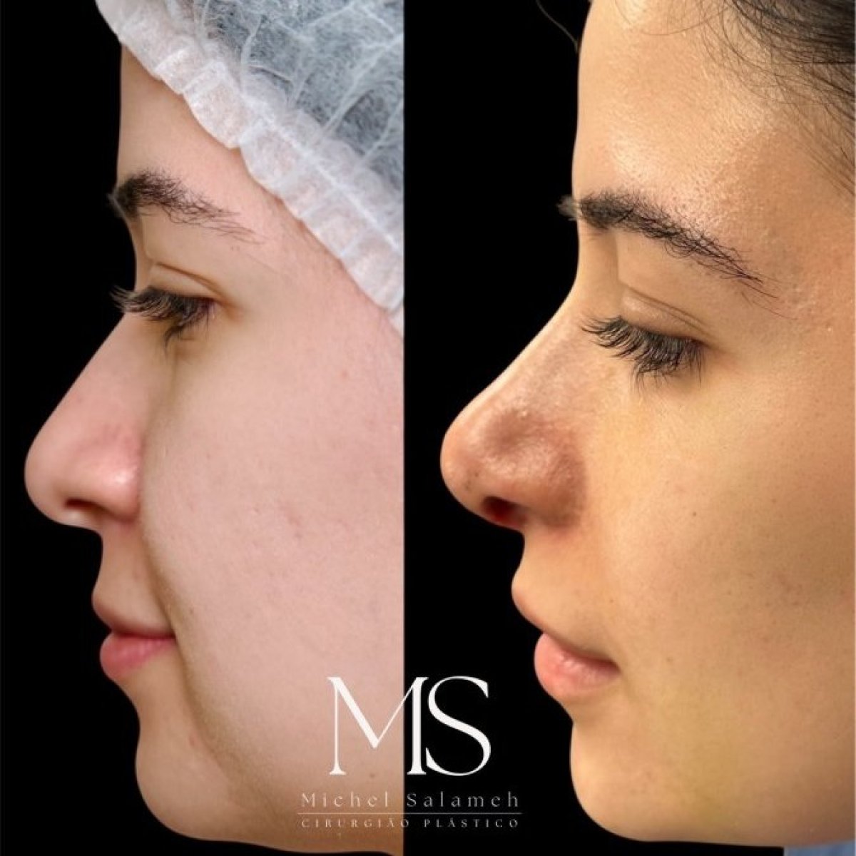 Résultats avant et après rhinoplastie chez Dr. Michel Salameh - Plastic And Aesthetic Surgery