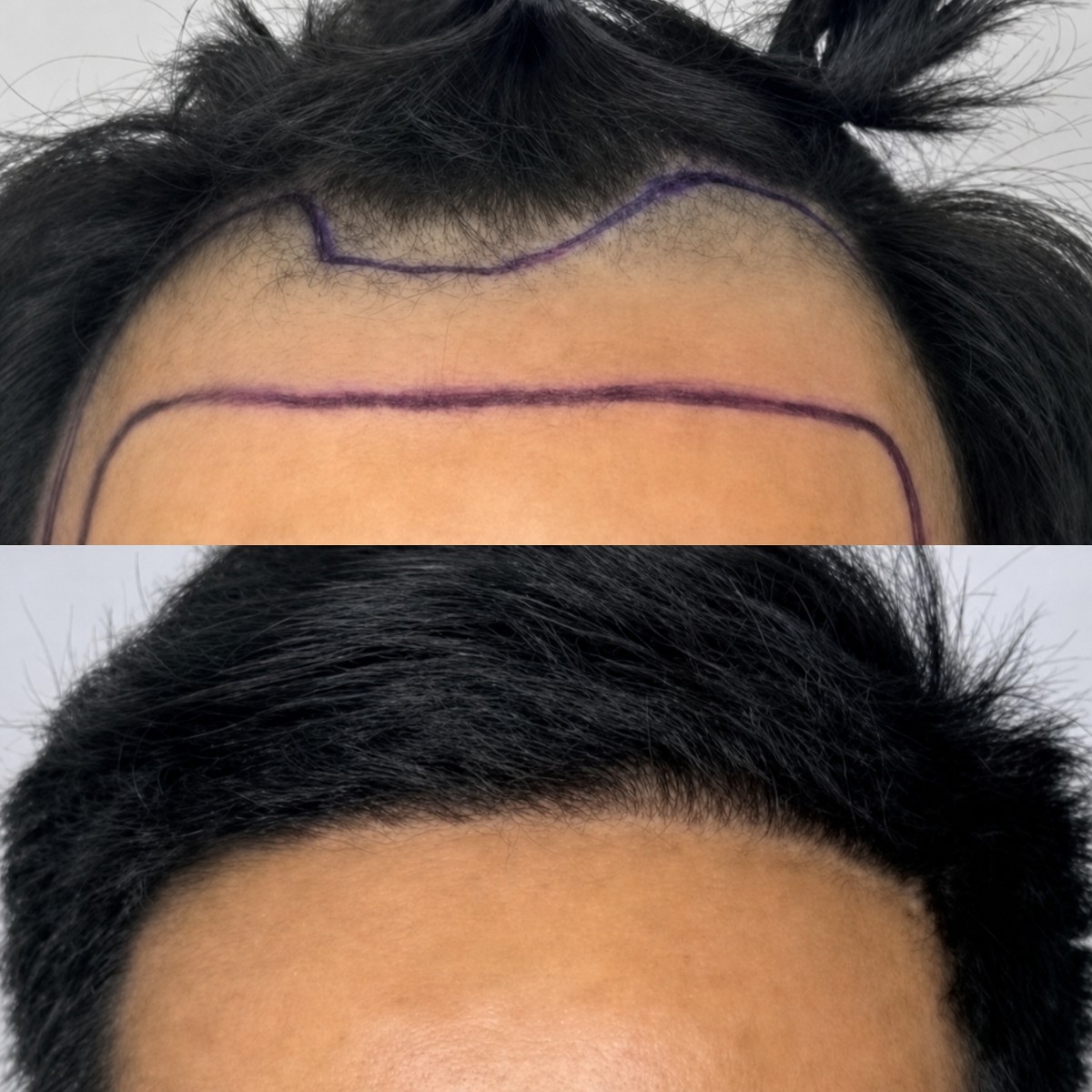 Before and after hair transplant results at Somchai Clinic, restored hairline and fuller hair