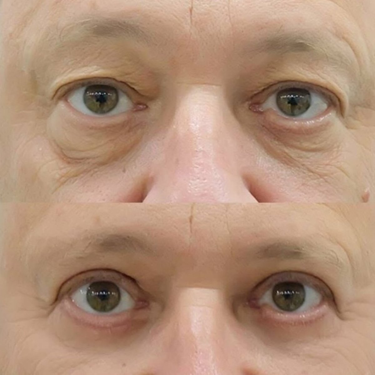 Before and after blepharoplasty results at Somchai Clinic, eyelid correction for youthful eyes
