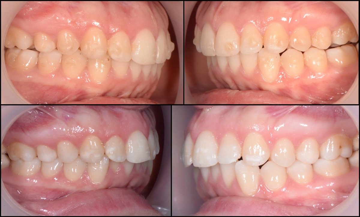 Before and after clear aligners results at RIKOTA Dental Clinic – improved teeth alignment