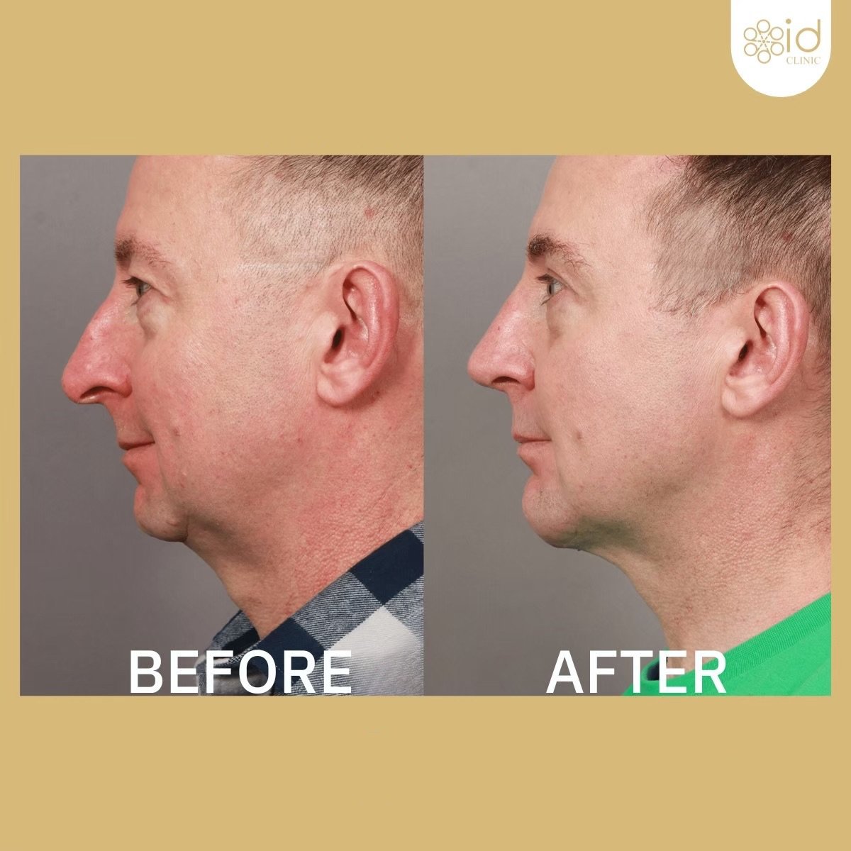 Before and after facial masculinization surgery results at ID Clinic Bangkok, profile improvement