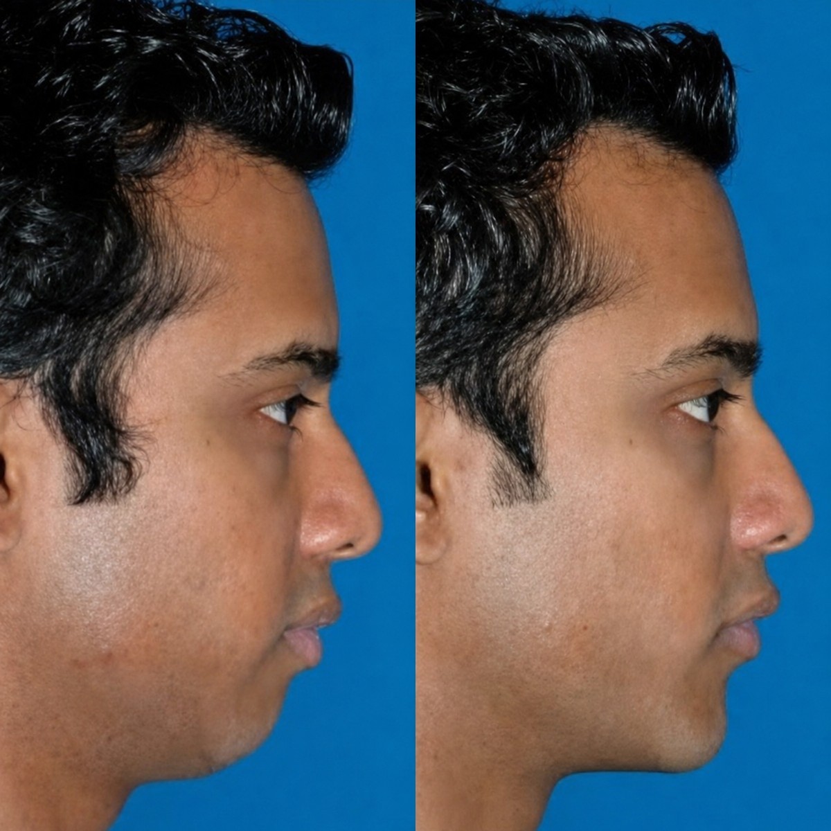 Before and after facial masculinization surgery results at ID Clinic Bangkok, jawline enhancement