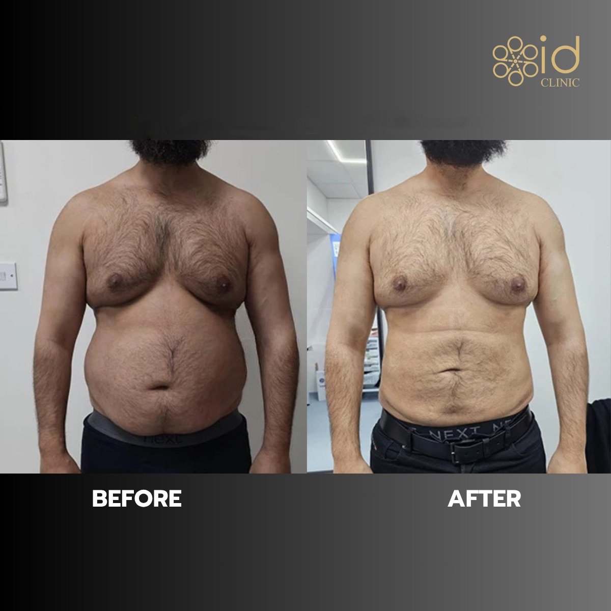 Before and after Vaser liposuction results at ID Clinic Bangkok, improved abdominal contour