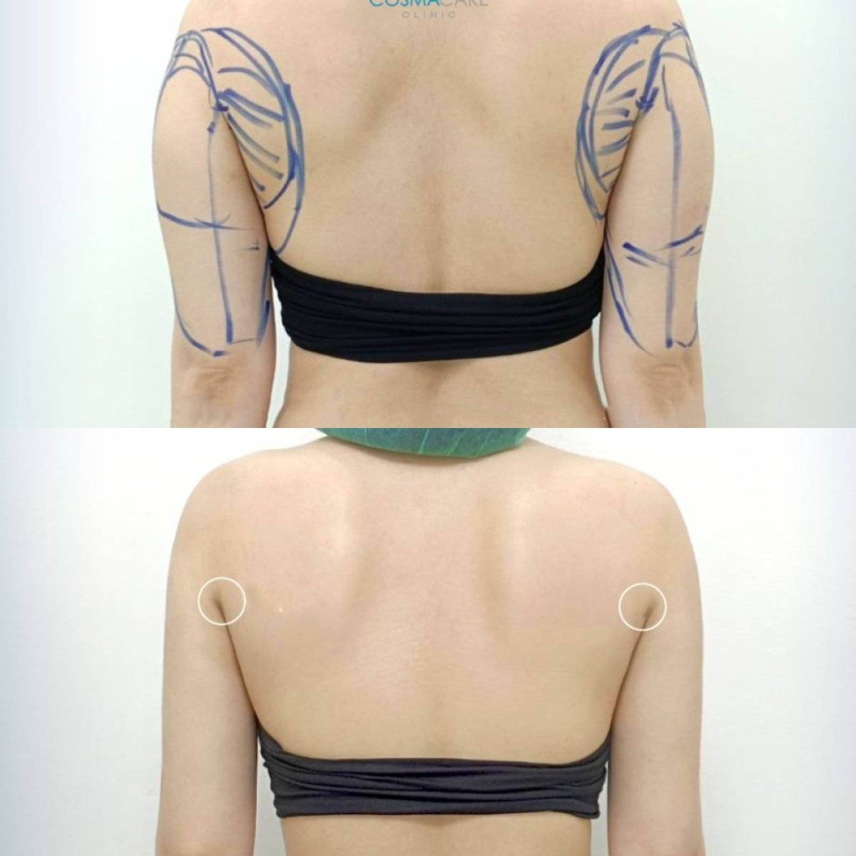 Resultados antes y después de lipoescultura Vaser de brazos en Cosmacare clinic