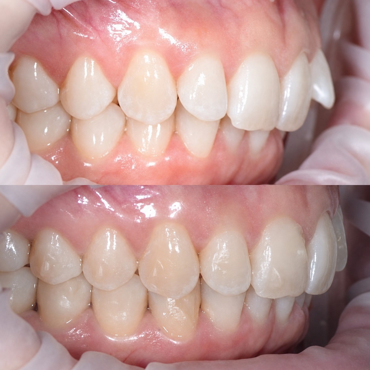 Before and after clear aligners results at RIKOTA Dental Clinic – improved teeth alignment