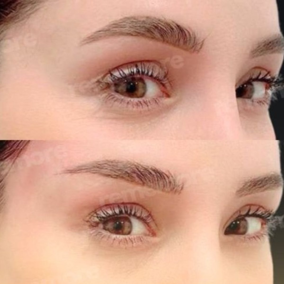 Before and after upper eyelid surgery results at Memorial Şişli Hospital, rejuvenated eyes