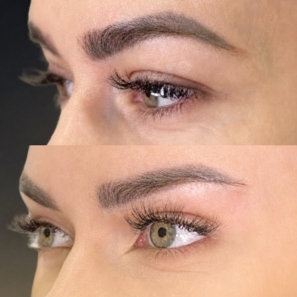 Resultados de blefaroplastia superior antes y después en Memorial Şişli Hospital, ojos rejuvenecidos