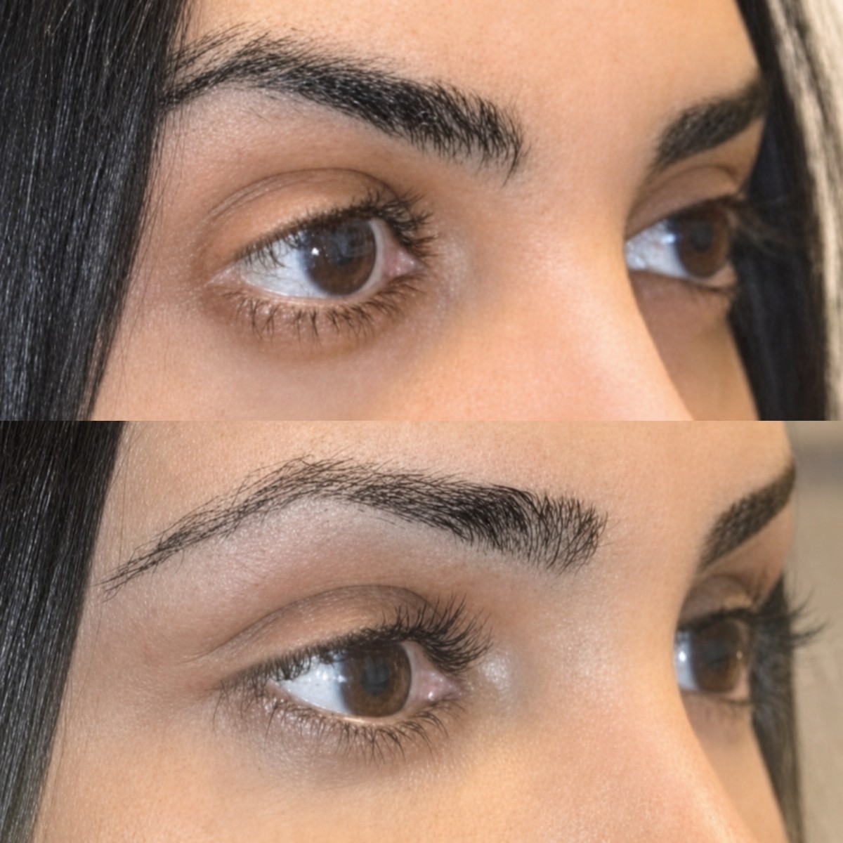 Before and after upper eyelid surgery results at Memorial Şişli Hospital, improved eye contour