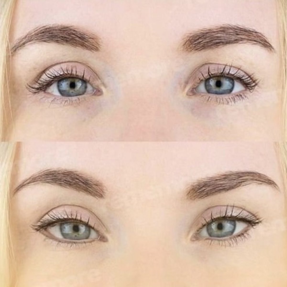 Resultados de blefaroplastia superior antes y después en Memorial Şişli Hospital, ojos rejuvenecidos