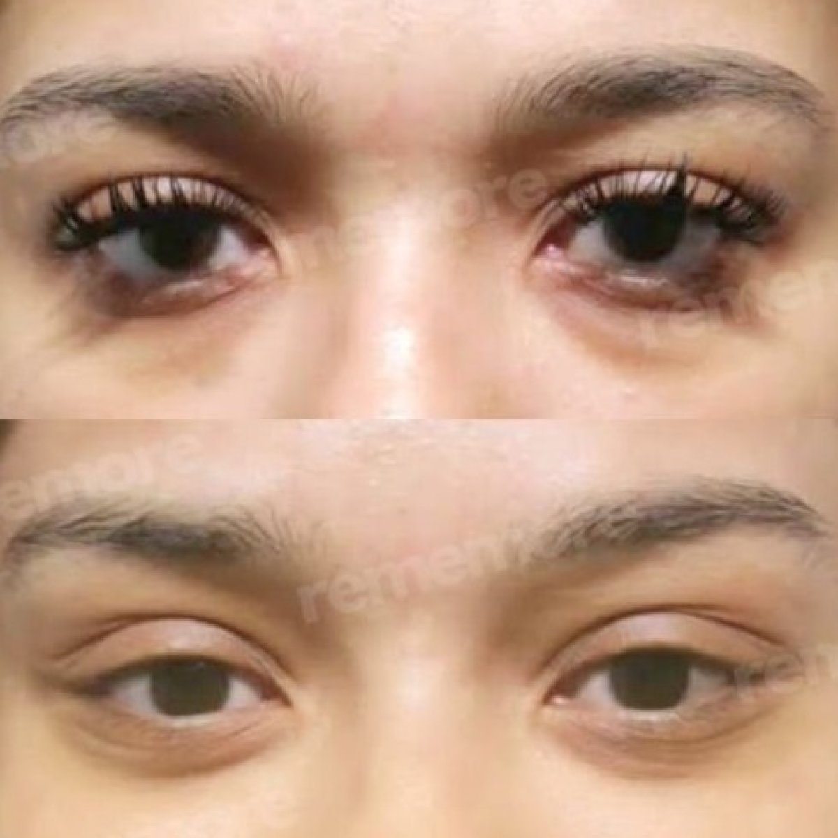 Upper eyelid surgery before and after results at Memorial Şişli Hospital, improved eye contour