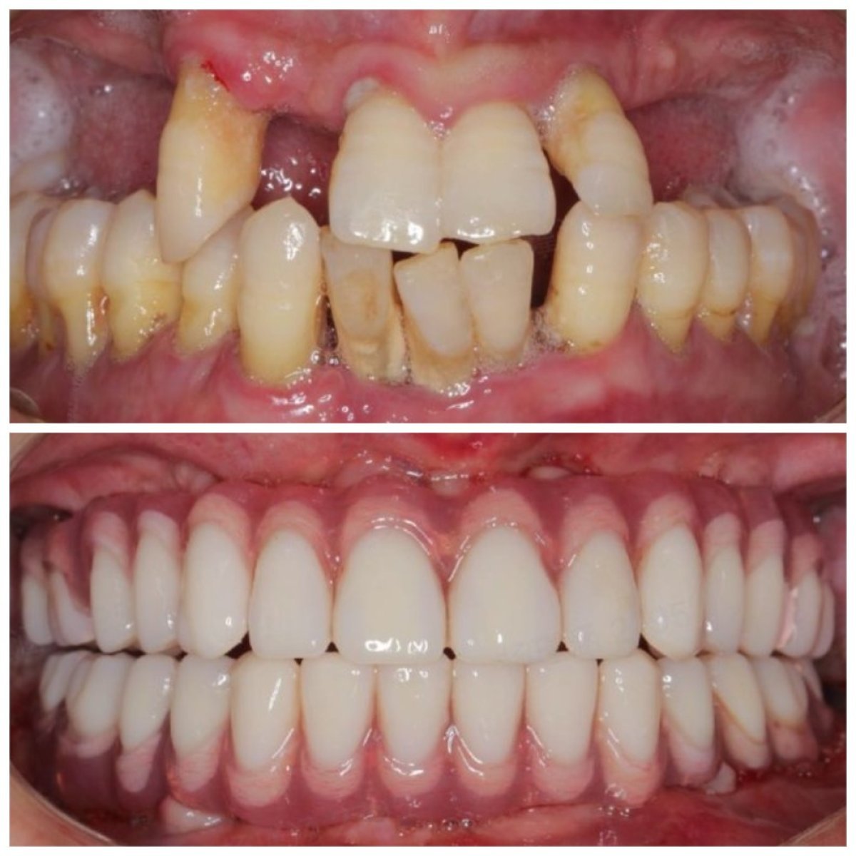 Before and after All-on-4 dental implants result – full mouth restoration and improved smile