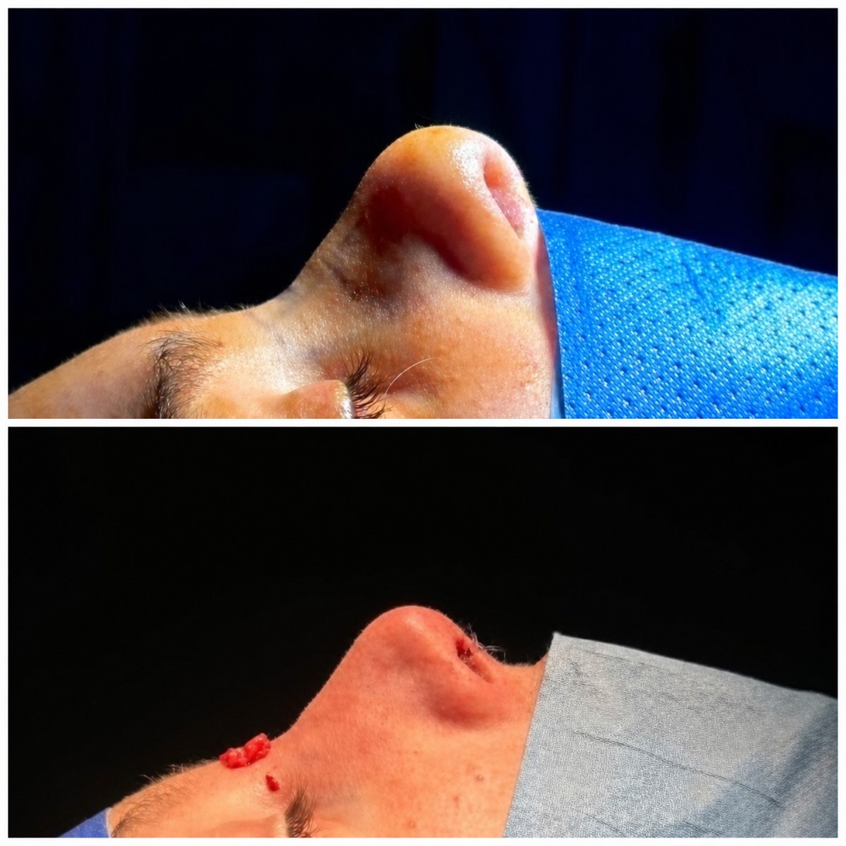 Resultados de rinoplastia antes y después, mejora de la forma y perfil nasal tras cirugía