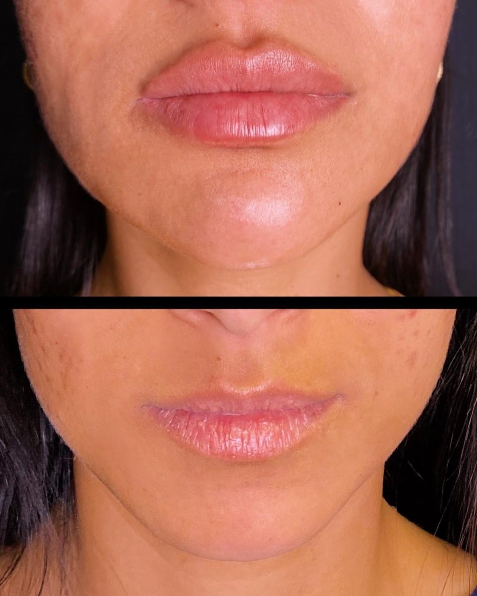 Resultado antes y después de rellenos de ácido hialurónico – labios más voluminosos