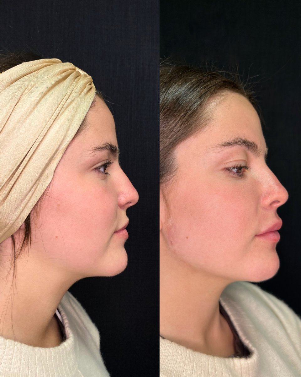 Before and after fillers injection result – enhanced chin and jawline contour improvement