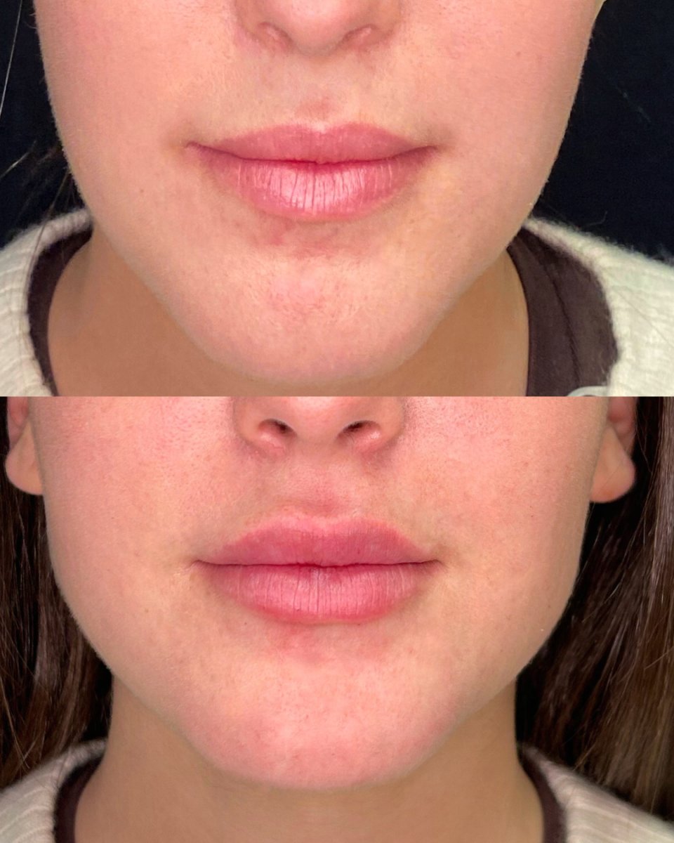 Before and after lip fillers injection result – enhanced lip volume and contour improvement