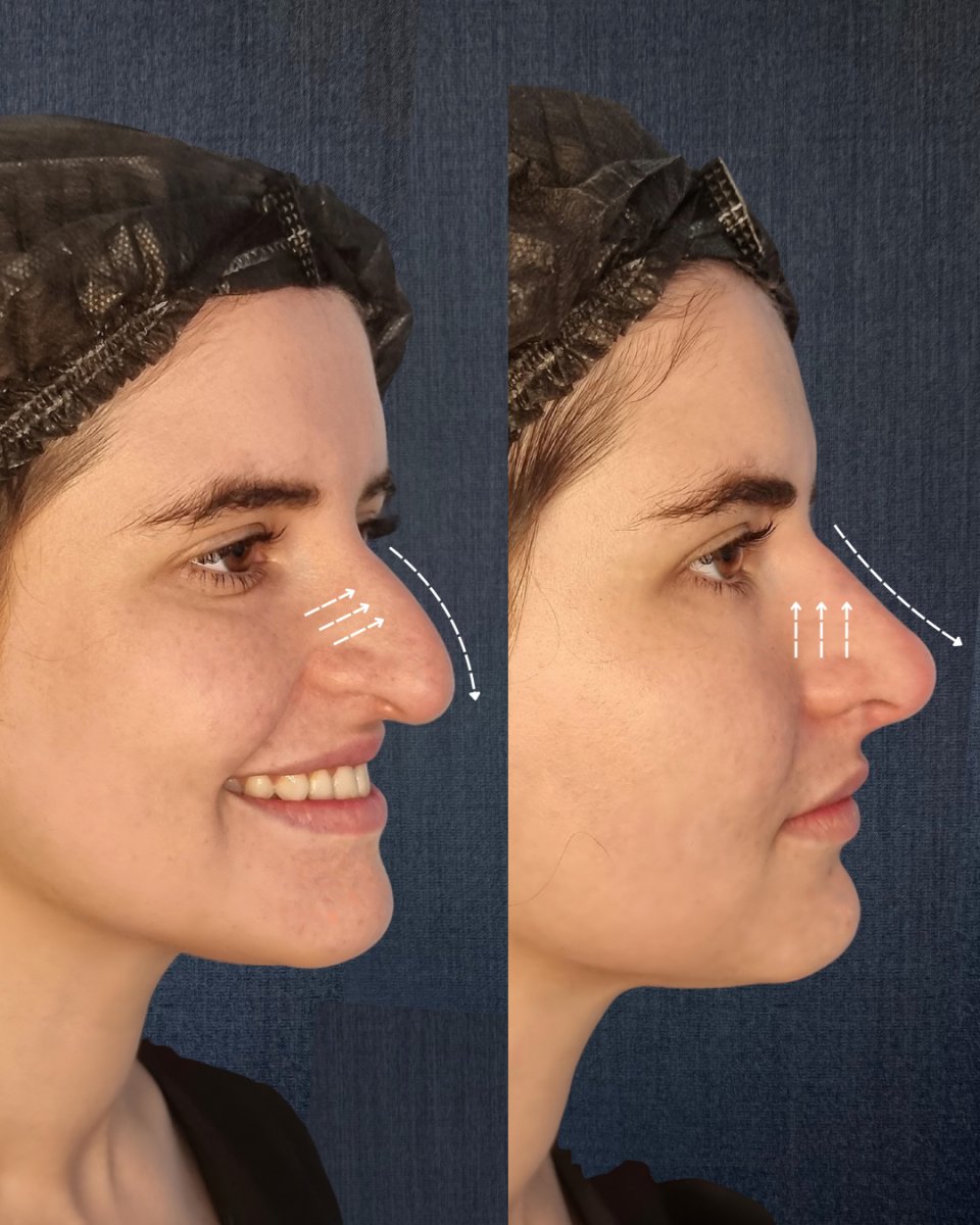 Before and after filler rhinoplasty results, non-surgical nose reshaping with natural look