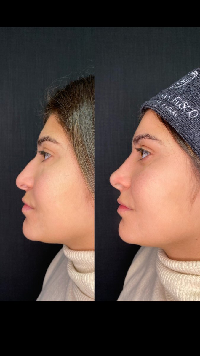 Resultados antes y después de rinoplastia con relleno – perfilado nasal sin cirugía