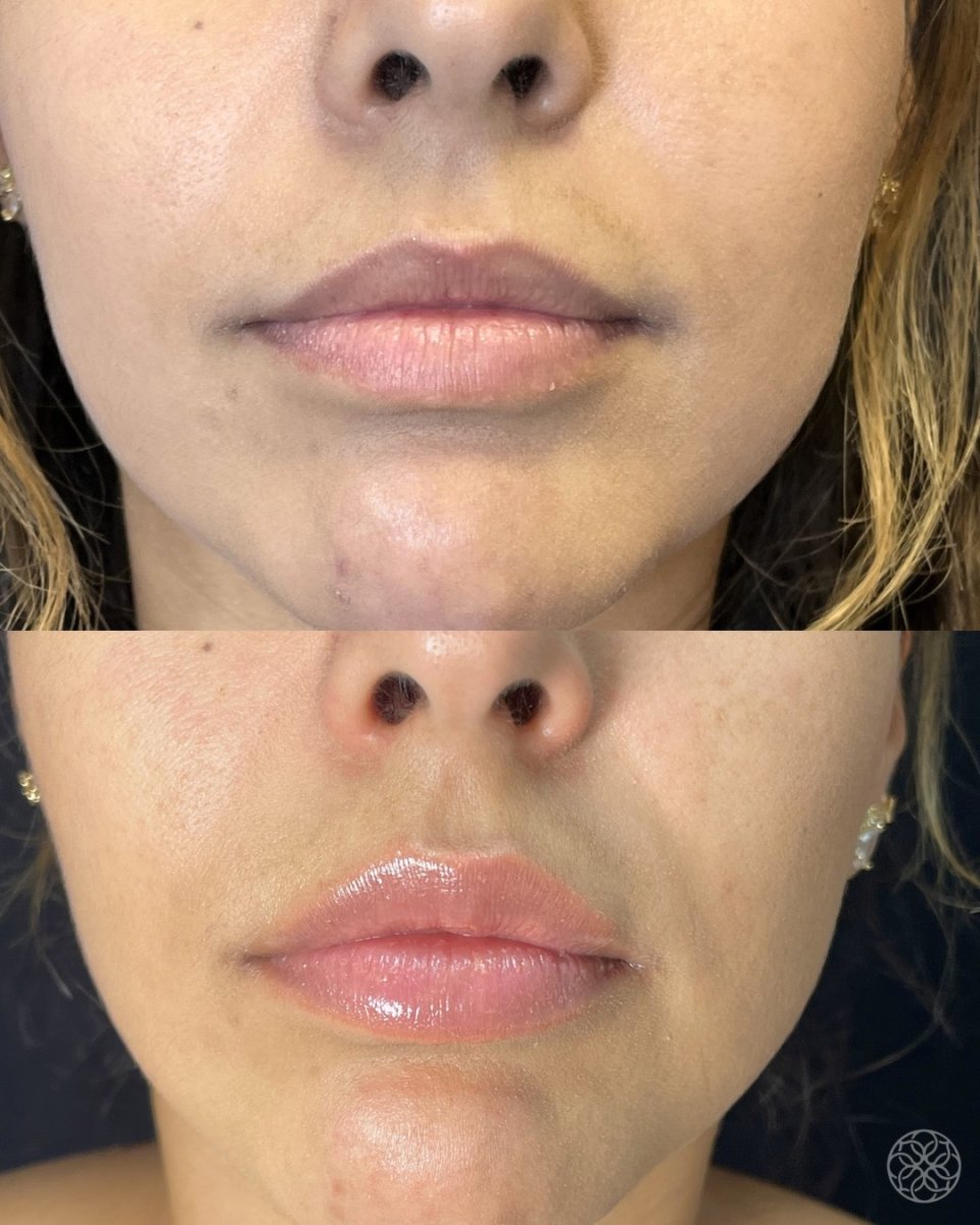 Before and after lip fillers injection results – enhanced lip volume and contour improvement