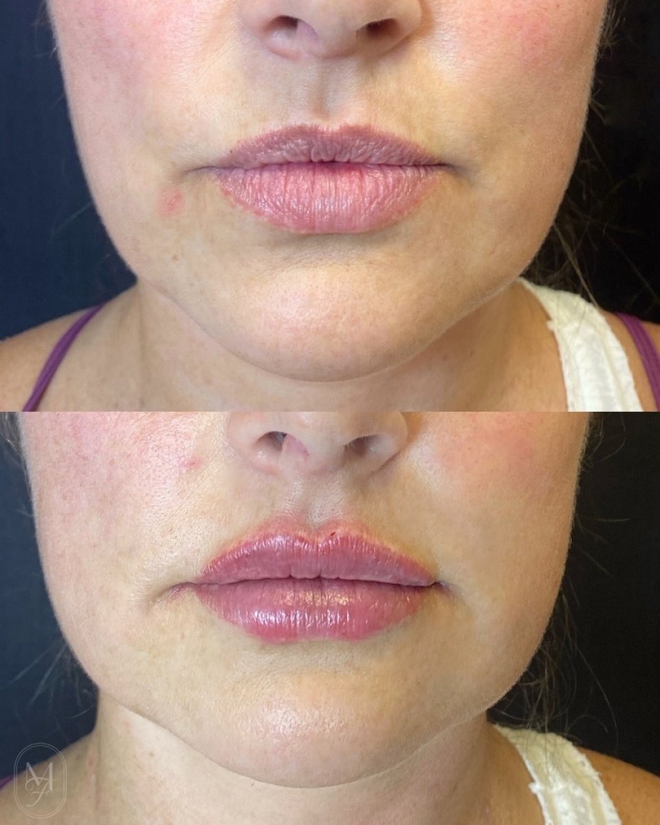 Before and after lip fillers injection results – enhanced lip volume and contour improvement