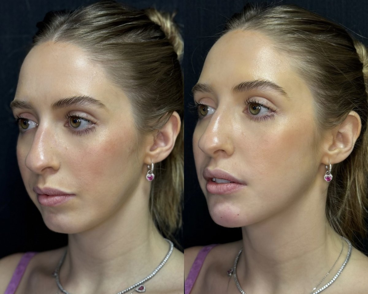 Before and after fillers injection result – enhanced lip volume and contour improvement
