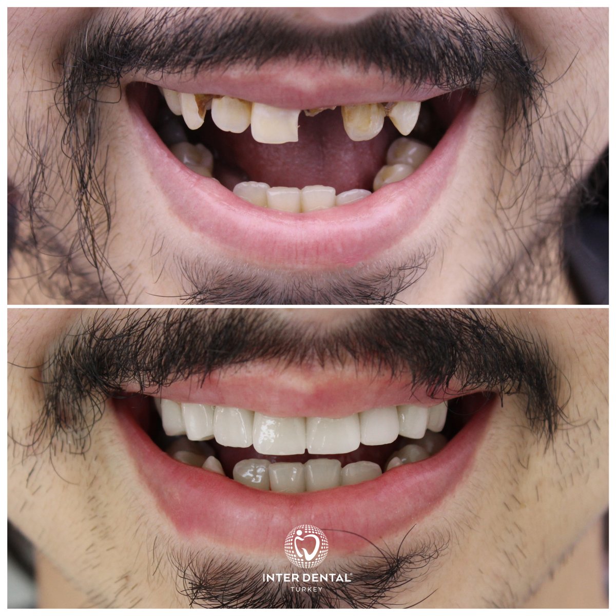 Before and after zirconia crown results at Inter Dental Turkey – restored smile transformation