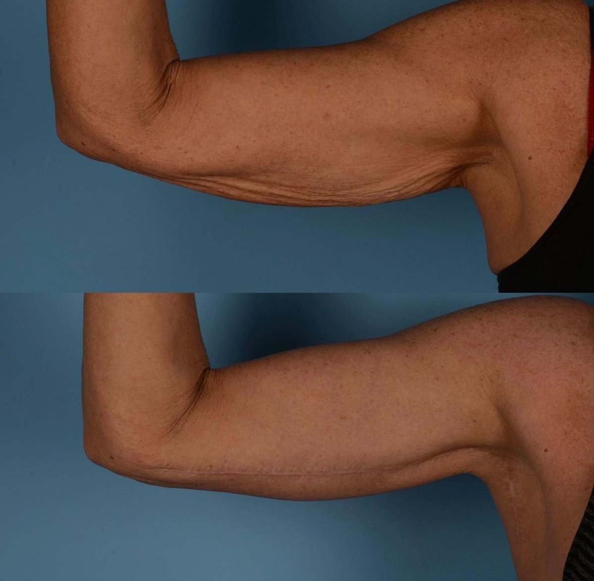 Resultados de lifting de brazos antes y después en Private Yüzyıl Hospital, brazos firmes
