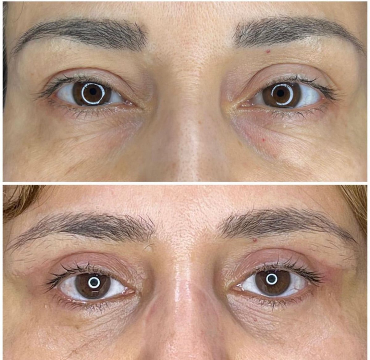 Before and after blepharoplasty results at Private Yüzyıl Hospital, eyelid correction