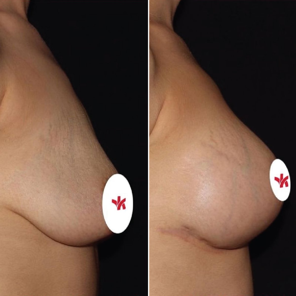 Before and after breast lift results at Private Yüzyıl Hospital, improved breast contour