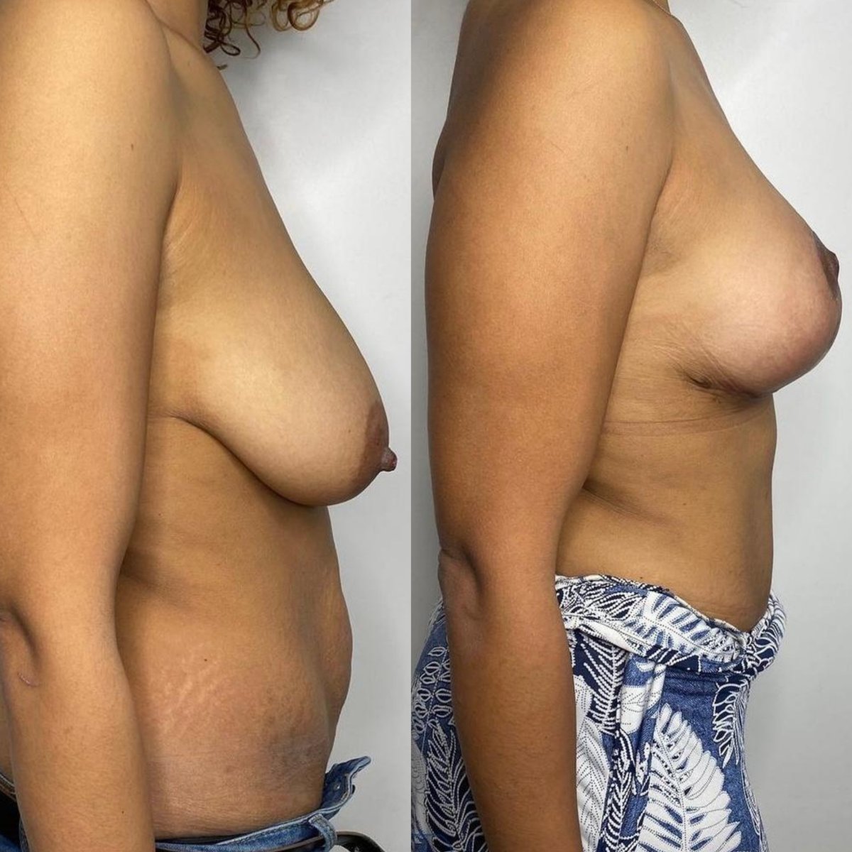 Before and after breast lift results at Private Yüzyıl Hospital, improved breast contour