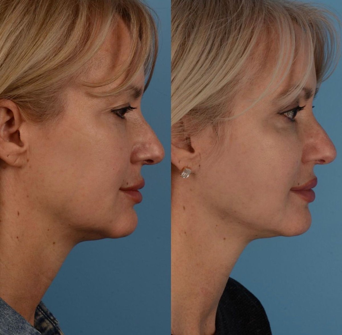 Facelift before and after results at Private Yüzyıl Hospital – visible jawline and neck lift