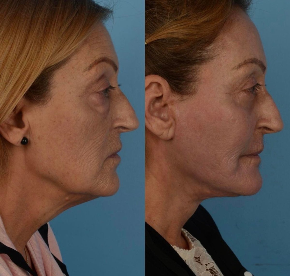 Resultados de lifting facial antes y después en Private Yüzyıl Hospital – rejuvenecimiento facial