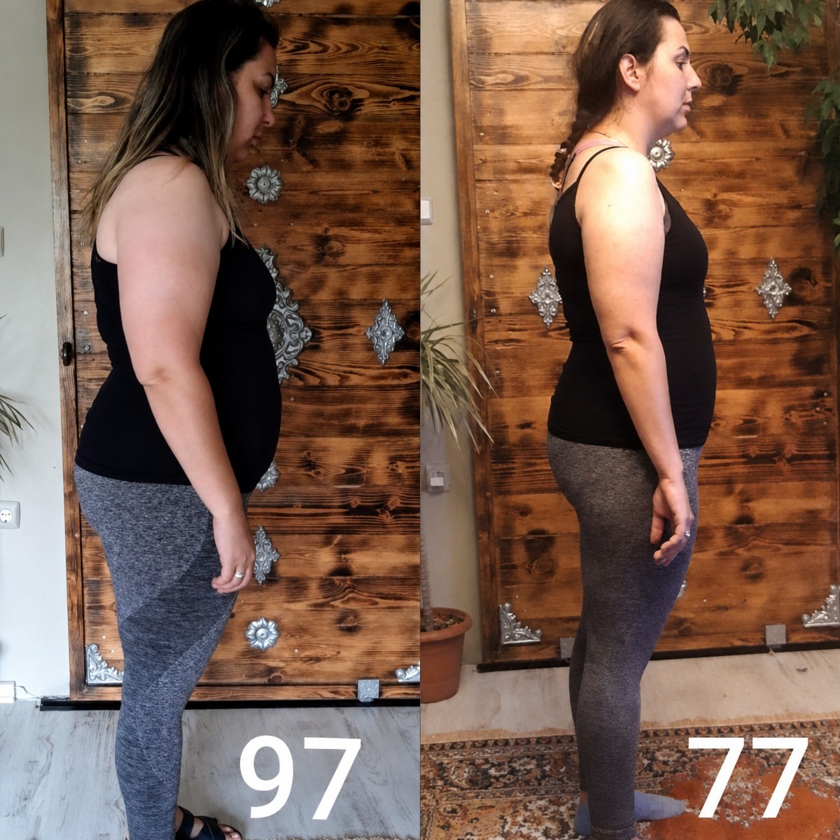 Before and after gastric sleeve surgery at Private Yüzyıl Hospital – visible weight loss results
