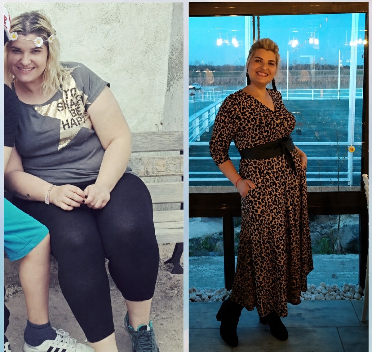 Before and after gastric sleeve surgery at Private Yüzyıl Hospital – visible weight loss result