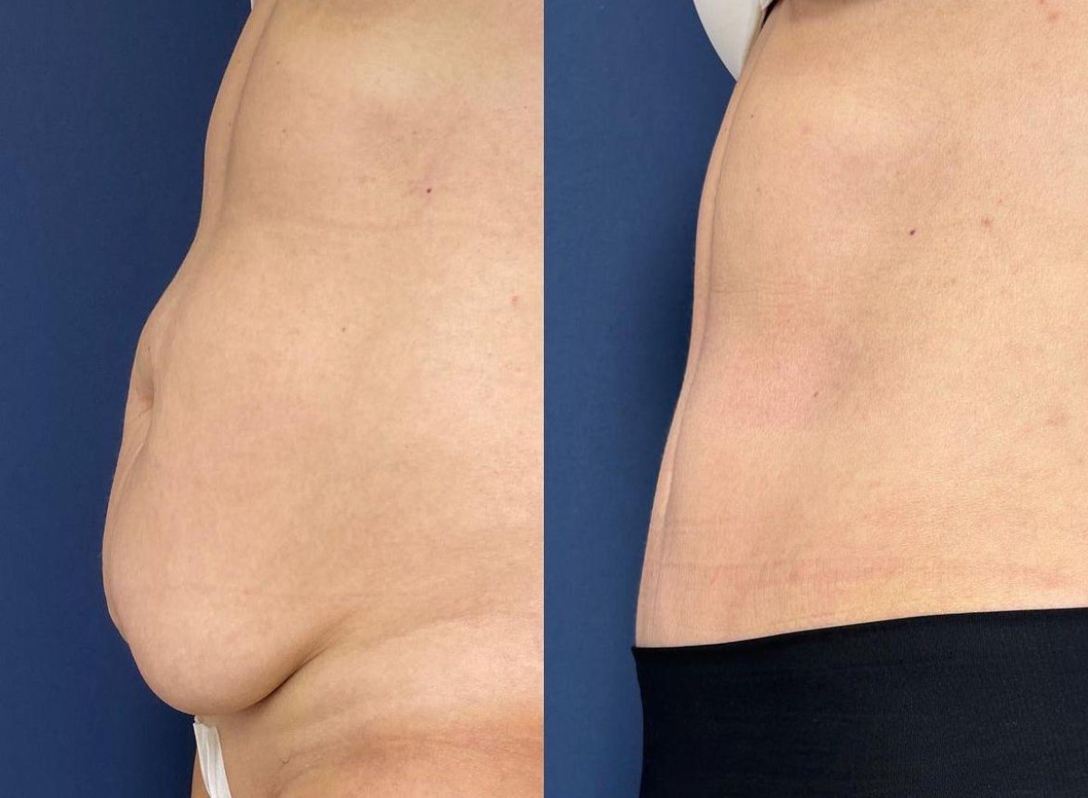 Resultados de liposucción antes y después en Private Yüzyıl Hospital, mejora del abdomen