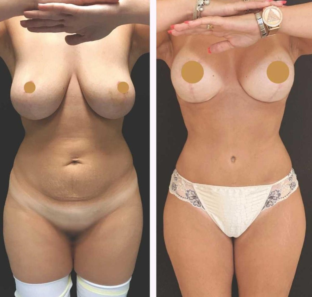 Mommy makeover before and after results at Private Yüzyıl Hospital – body contour improvement