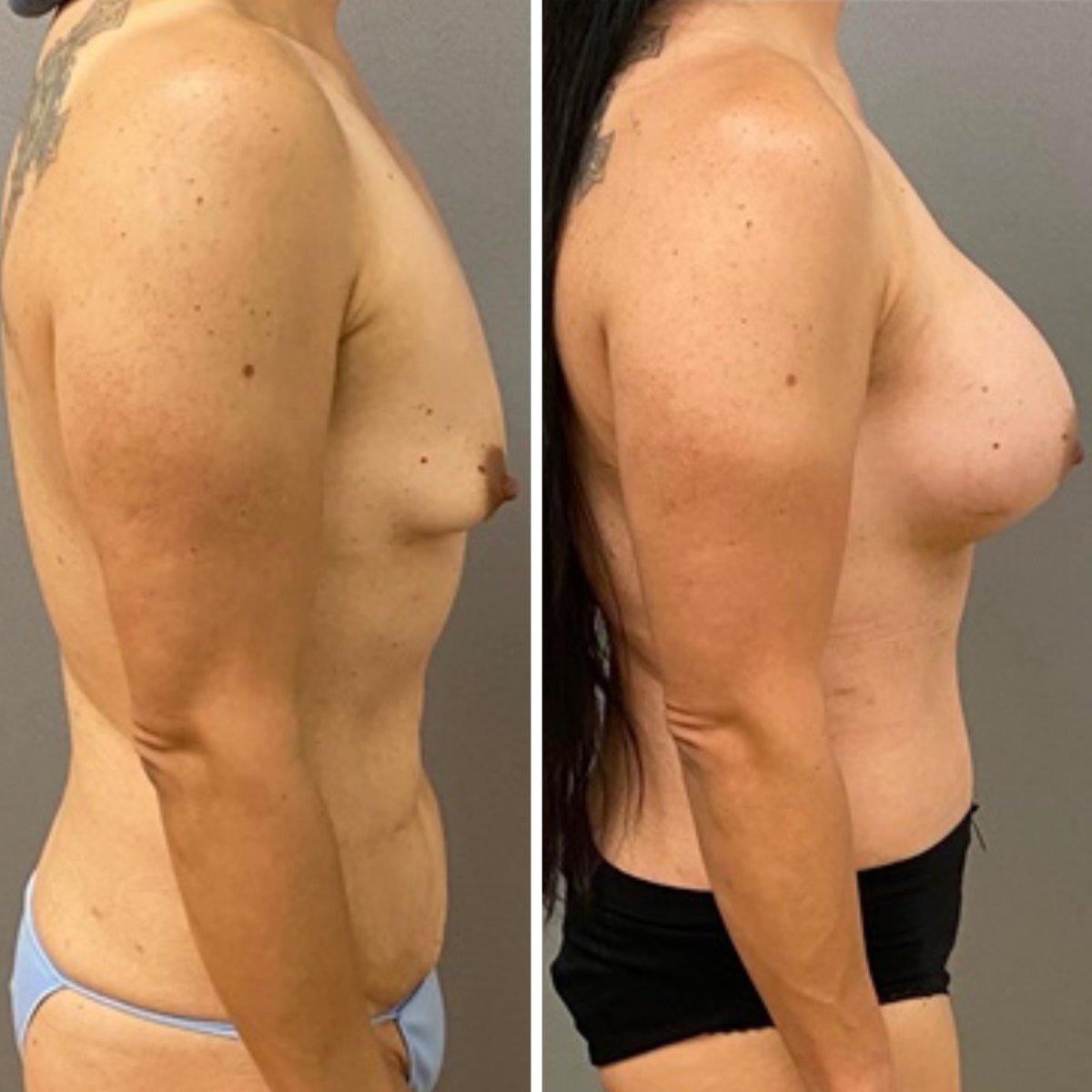 Antes y después de mommy makeover en Private Yüzyıl Hospital, resultados visibles en pecho y cuerpo