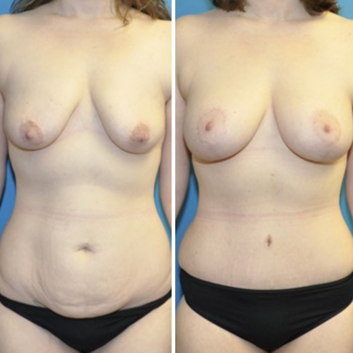 Resultados de mommy makeover antes y después en Private Yüzyıl Hospital, mejora corporal